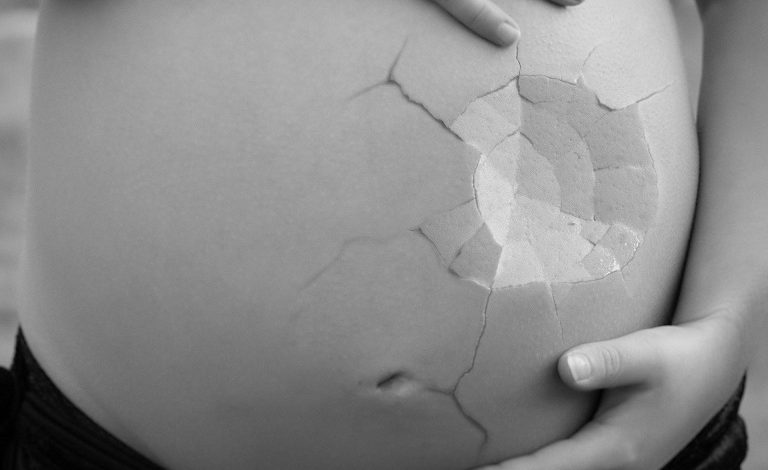 راههای درمان ترک های پوستی دوران بارداری